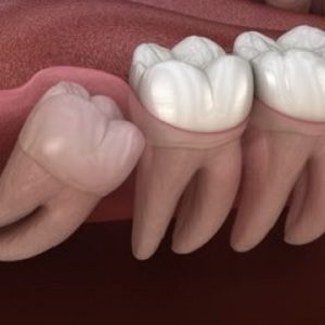 Wisdom teeth pain